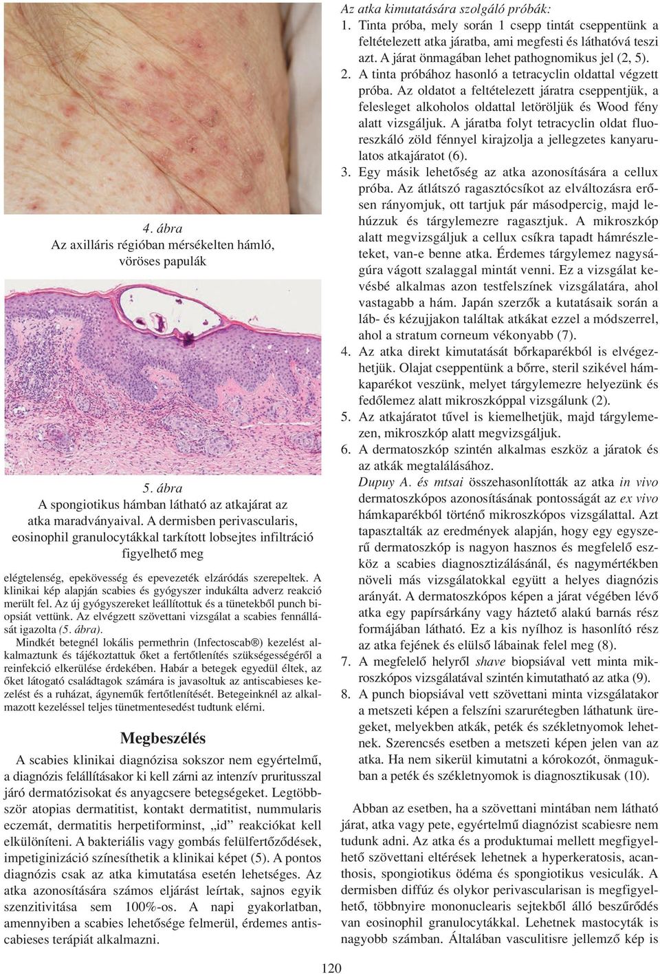 A klinikai kép alapján scabies és gyógyszer indukálta adverz reakció merült fel. Az új gyógyszereket leállítottuk és a tünetekbôl punch biopsiát vettünk.