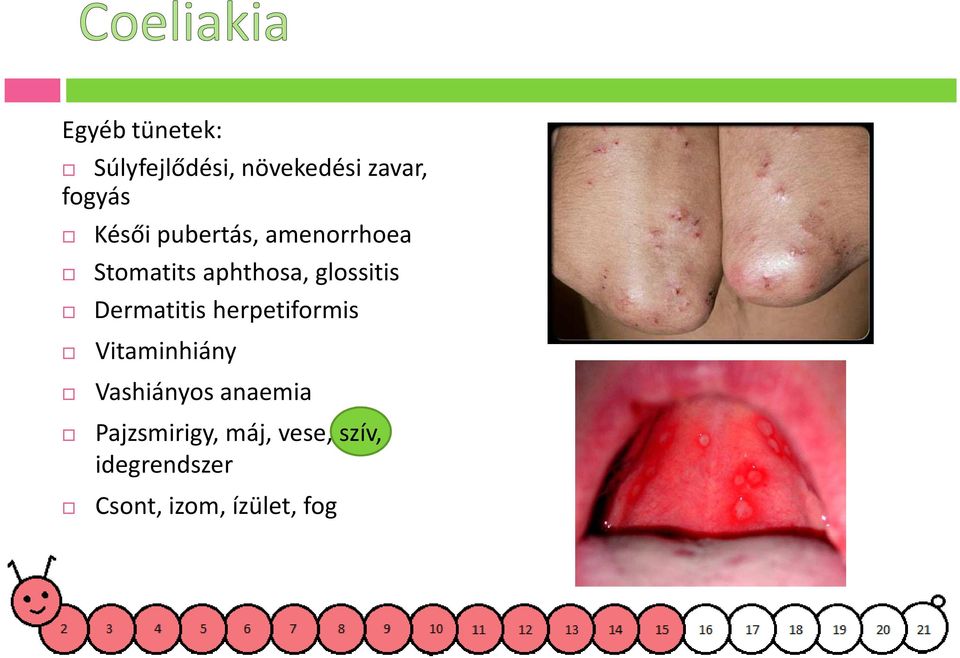 Dermatitis herpetiformis Vitaminhiány Vashiányos anaemia