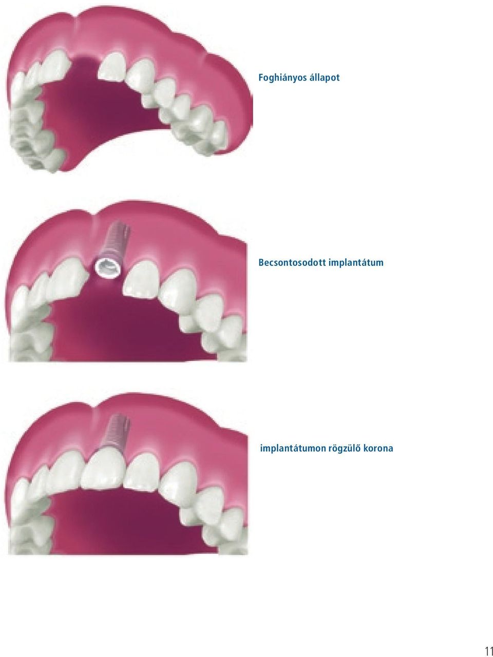 implantátum