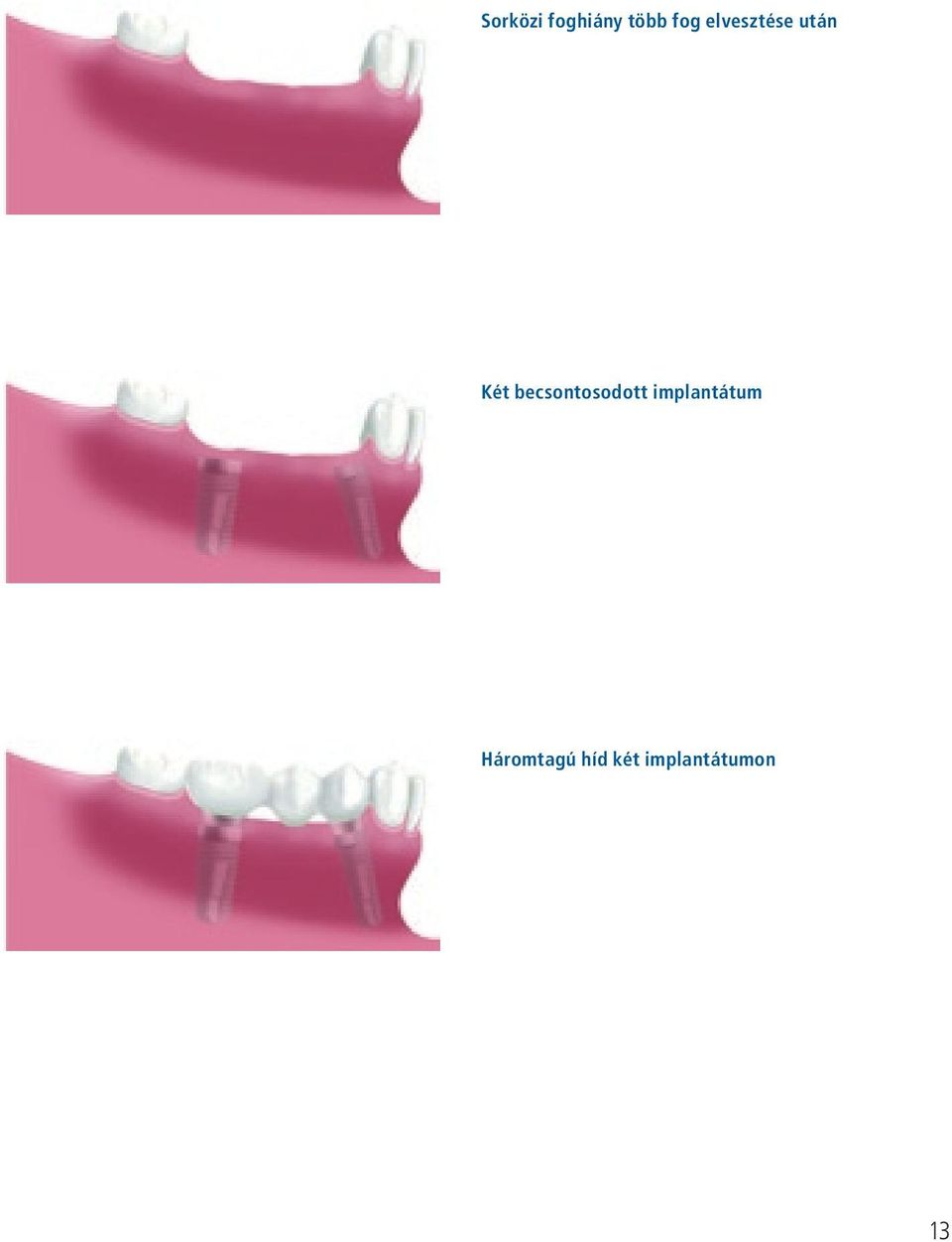 becsontosodott implantátum