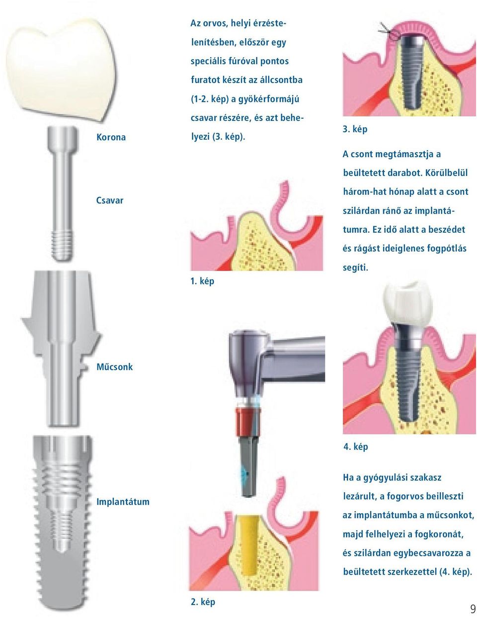 Körülbelül három-hat hónap alatt a csont szilárdan ránô az implantátumra. Ez idô alatt a beszédet és rágást ideiglenes fogpótlás segíti. Mûcsonk 4.