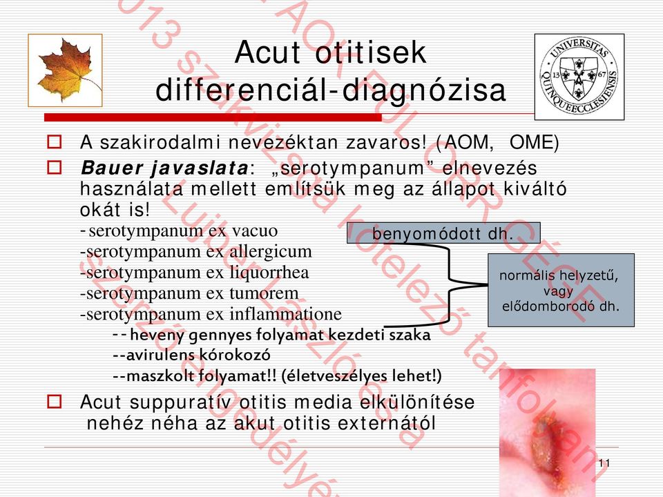 -serotympanum ex vacuo benyomódott dh.