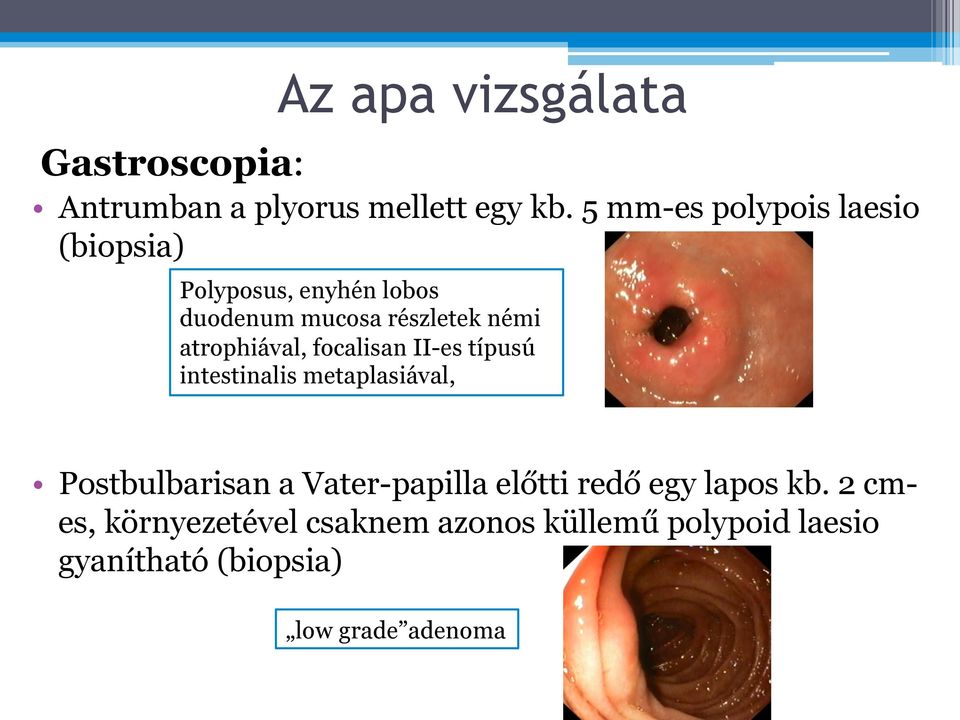 atrophiával, focalisan II-es típusú intestinalis metaplasiával, Postbulbarisan a Vater-papilla