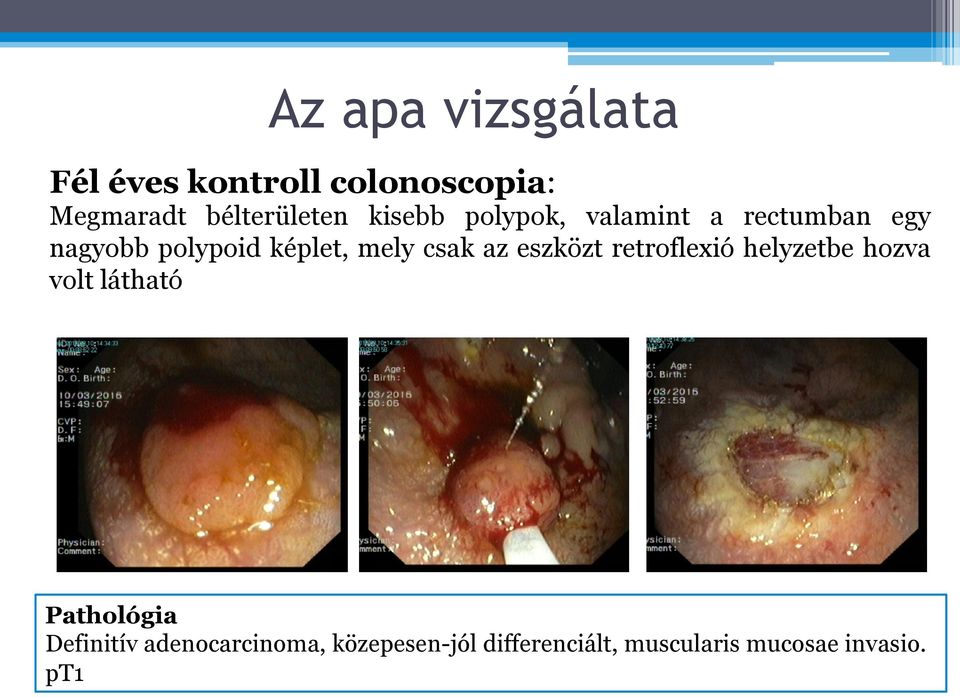 csak az eszközt retroflexió helyzetbe hozva volt látható Pathológia