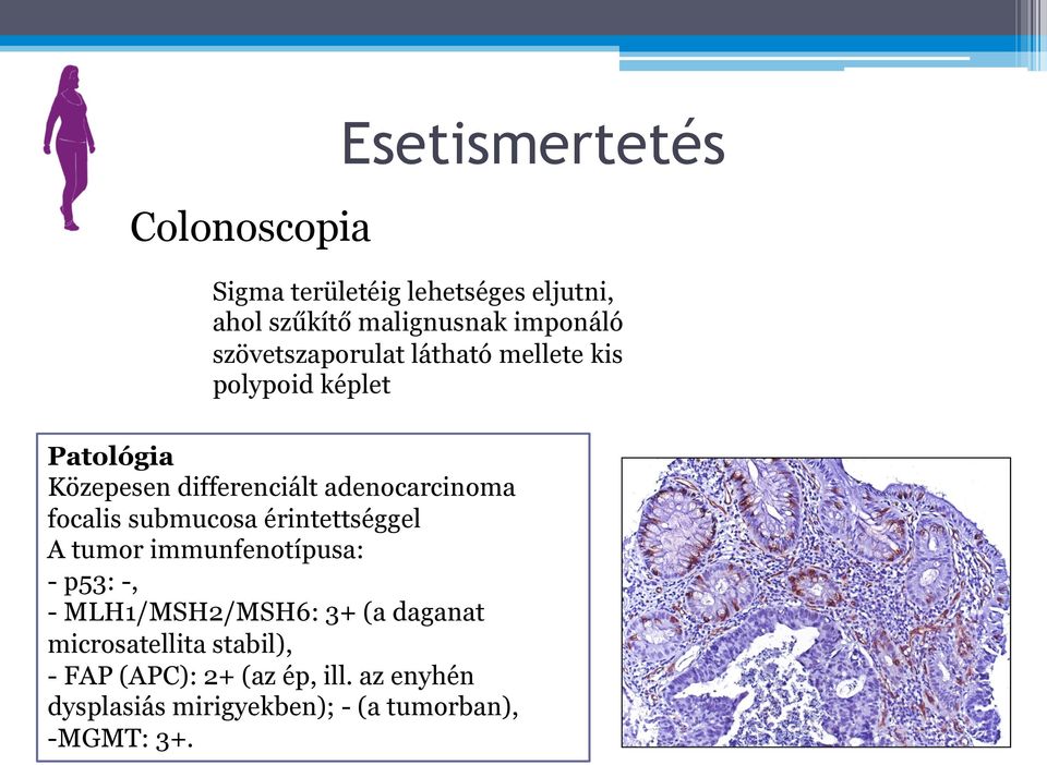 focalis submucosa érintettséggel A tumor immunfenotípusa: - p53: -, - MLH1/MSH2/MSH6: 3+ (a daganat