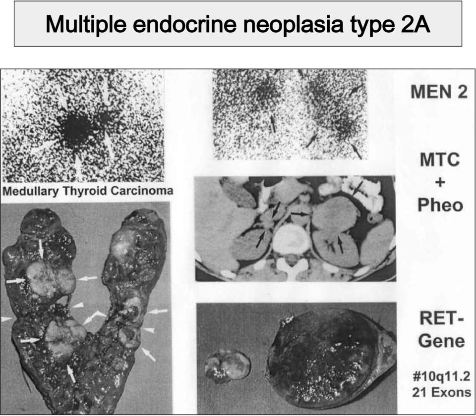 neoplasia