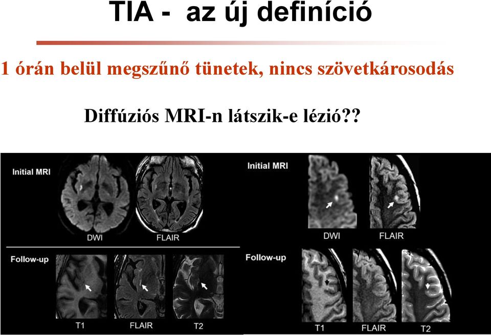 szövetkárosodás Diffúziós MRI-n