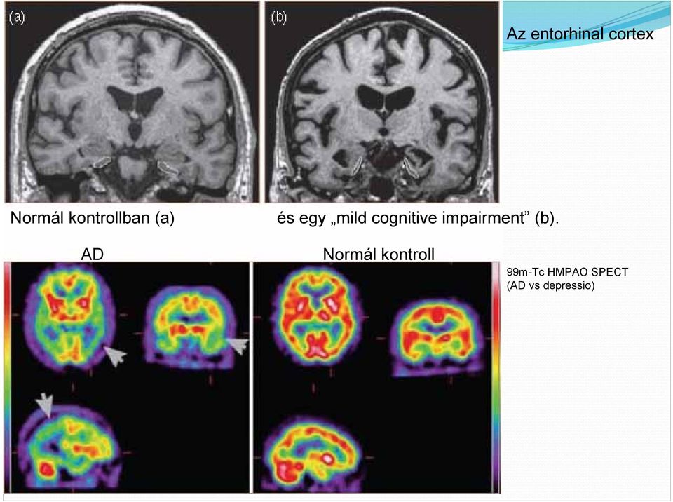 cognitive impairment (b).