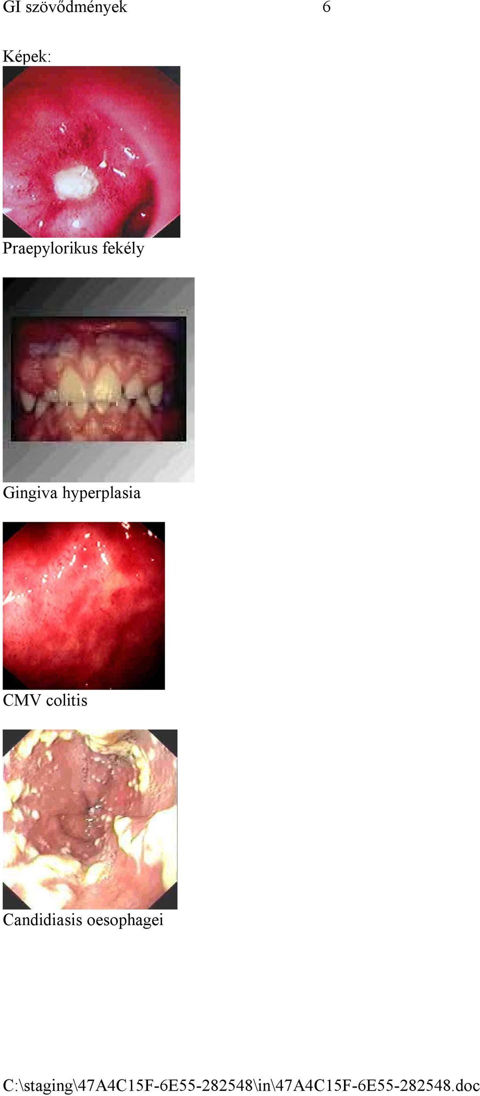 Gingiva hyperplasia CMV