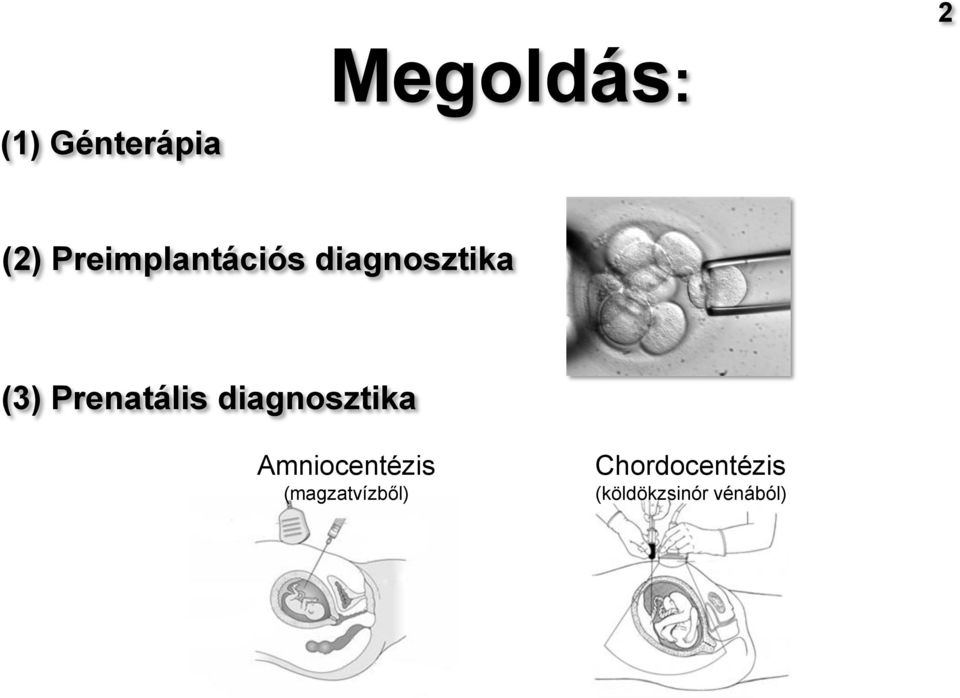 Prenatális diagnosztika Amniocentézis