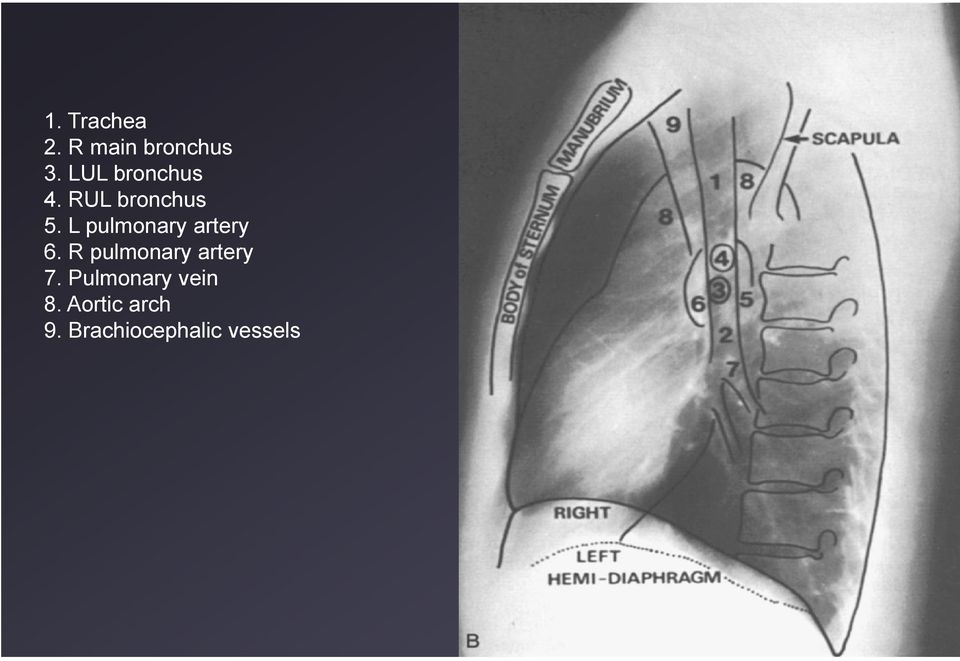 L pulmonary artery 6.
