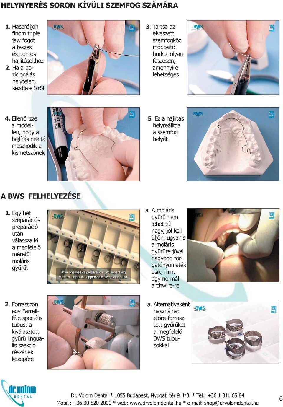 Ez a hajlítás helyreállítja a szemfog helyét A BWS FELHELYEZÉSE 1. Egy hét szeparációs preparáció után válassza ki a megfelelő méretű moláris gyűrűt 2.