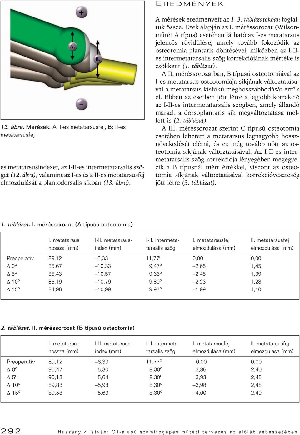 méréssorozat (Wilsonmûtét A típus) esetében látható az I-es metatarsus jelentôs rövidülése, amely tovább fokozódik az osteotomia plantaris döntésével, miközben az I-IIes intermetatarsalis szög