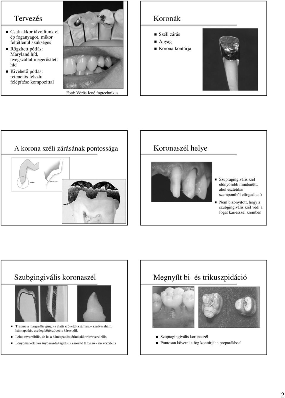 elfogadható Nem bizonyított, hogy a szubgingivális szél védi a fogat kariesszel szemben Szubgingivális koronaszél Megnyílt bi- és trikuszpidáció Trauma a marginális gingiva alatti szövetek számára