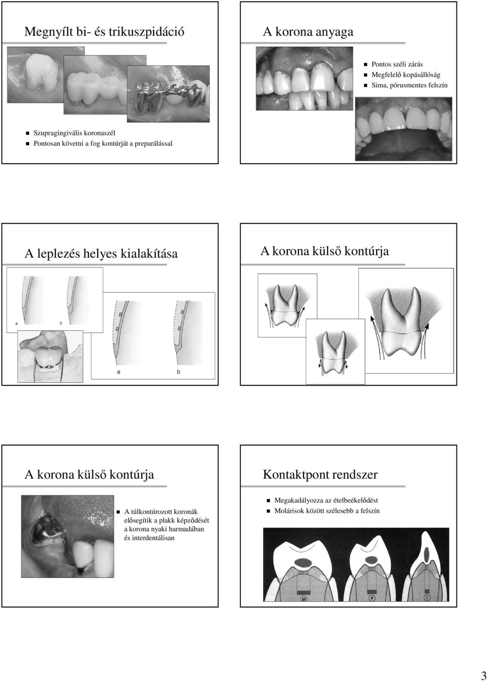 külső kontúrja A korona külső kontúrja Kontaktpont rendszer A túlkontúrozott koronák elősegítik a plakk képződését