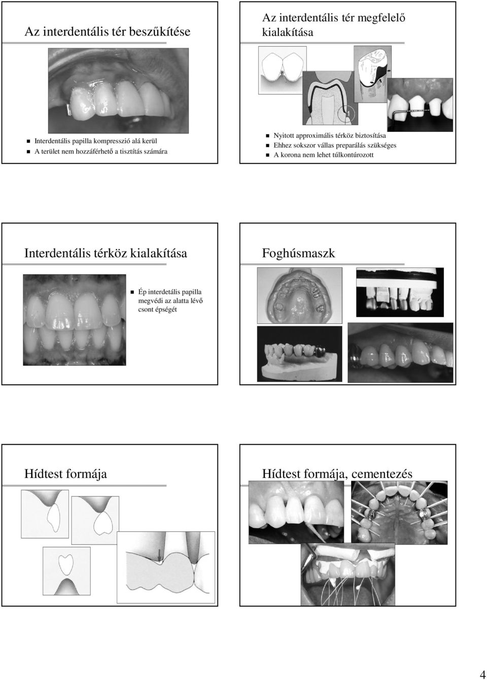 Ehhez sokszor vállas preparálás szükséges A korona nem lehet túlkontúrozott Interdentális térköz kialakítása