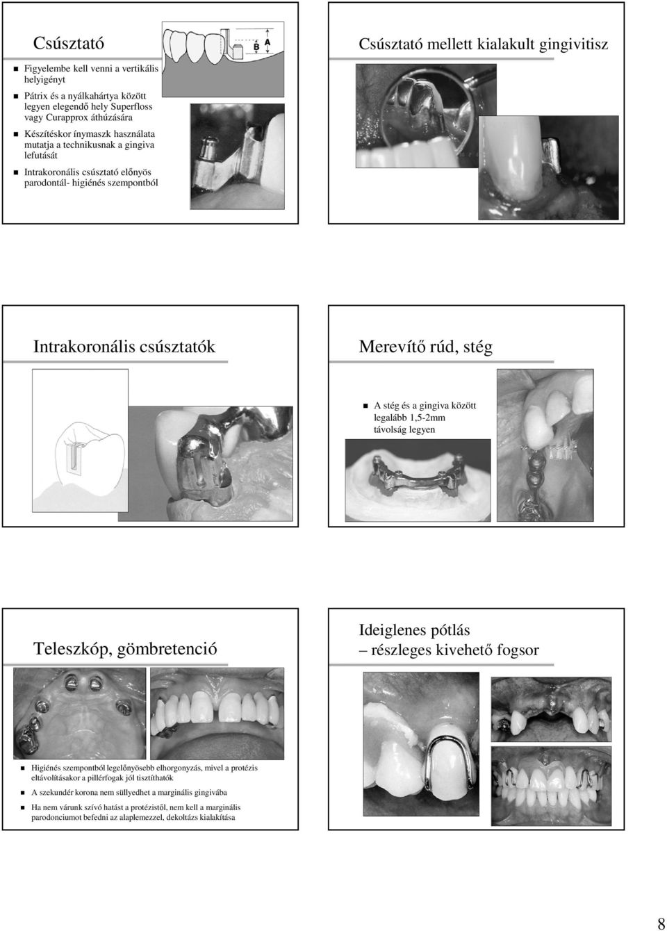 között legalább 1,5-2mm távolság legyen Teleszkóp, gömbretenció Ideiglenes pótlás részleges kivehető fogsor Higiénés szempontból legelőnyösebb elhorgonyzás, mivel a protézis eltávolításakor a