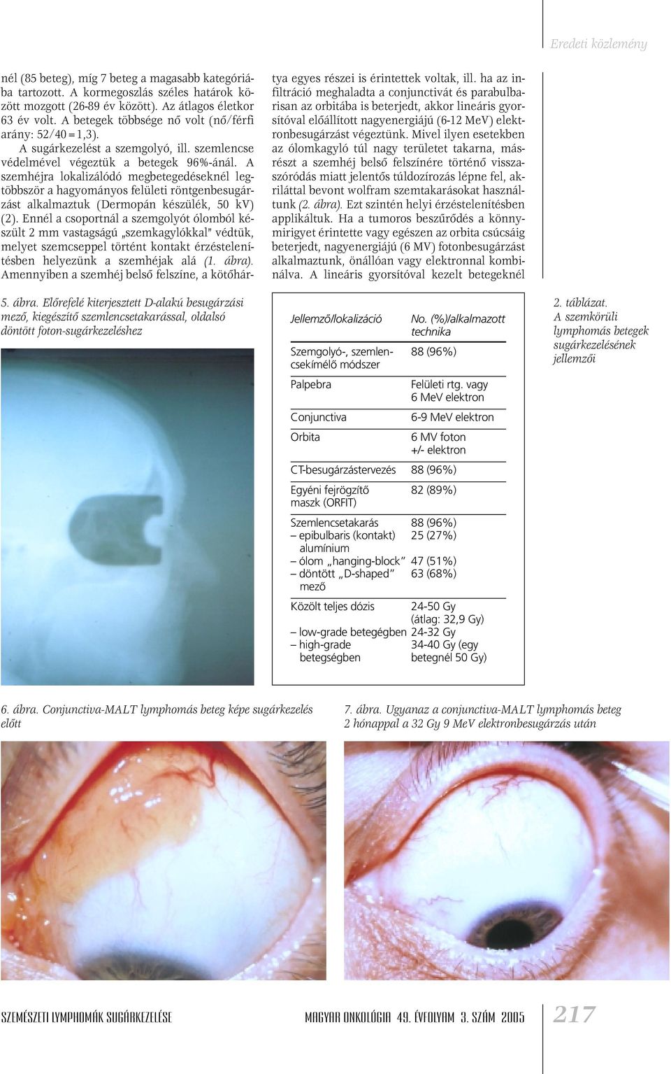 szemlencse védelmével végeztük a betegek 96%-ánál. A szemhéjra lokalizálódó megbetegedéseknél legtöbbször a hagyományos felületi röntgenbesugárzást alkalmaztuk (Dermopán készülék, 50 kv) (2).