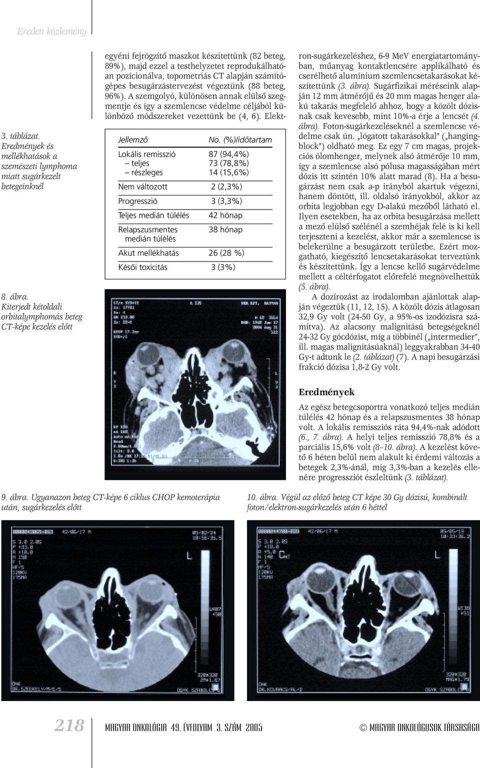 Akut mellékhatás 26 (28 %) Késôi toxicitás 3 (3%) egyéni fejrögzítô maszkot készítettünk (82 beteg, 89%), majd ezzel a testhelyzetet reprodukálhatóan pozícionálva, topometriás CT alapján számítógépes