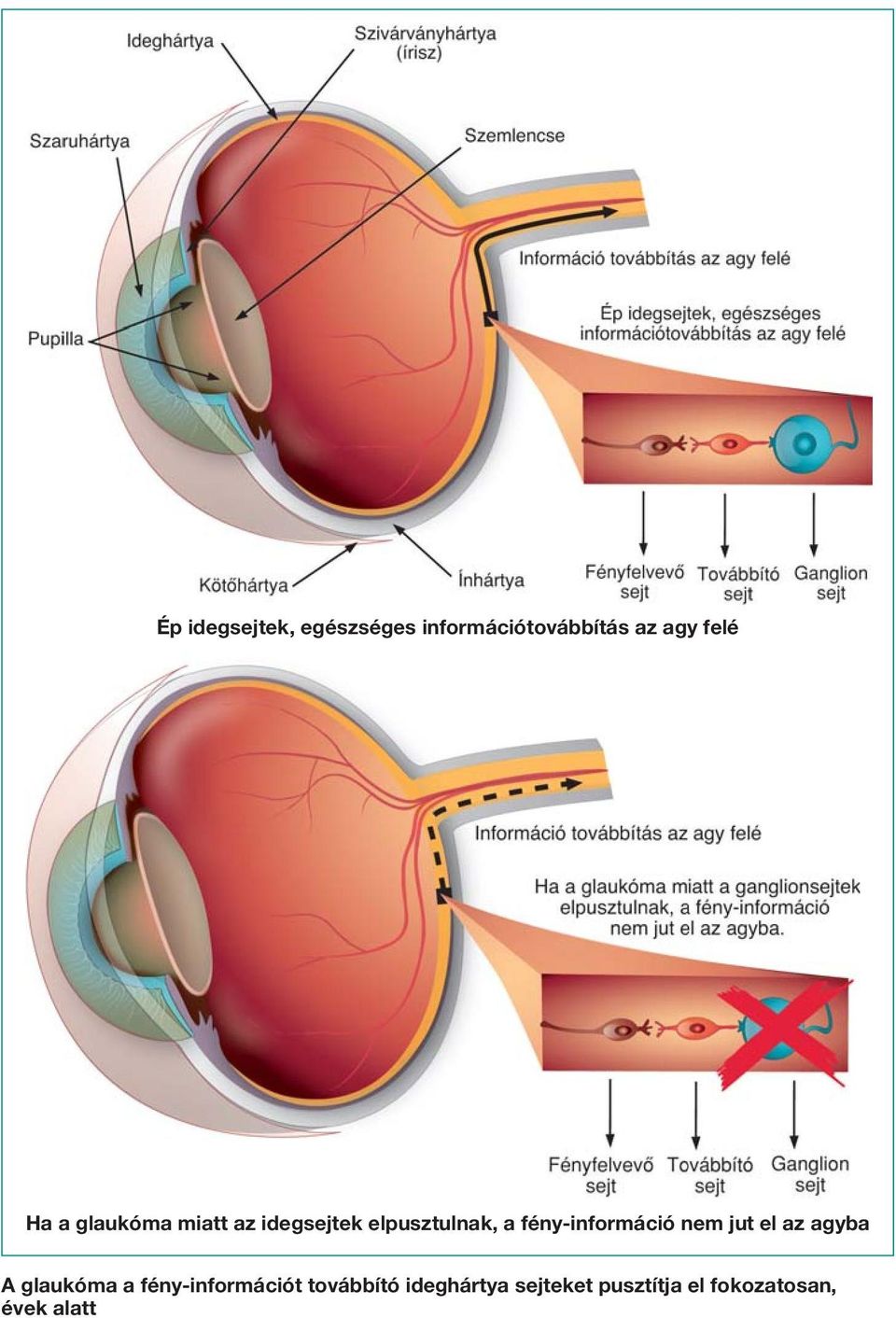 fény-információ nem jut el az agyba A glaukóma a