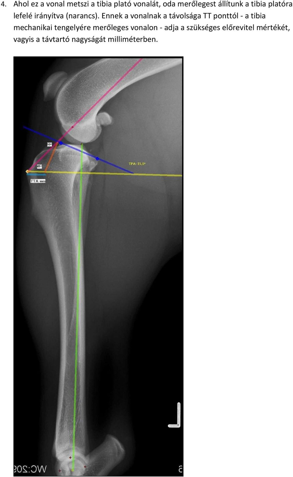 Ennek a vonalnak a távolsága TT ponttól - a tibia mechanikai tengelyére