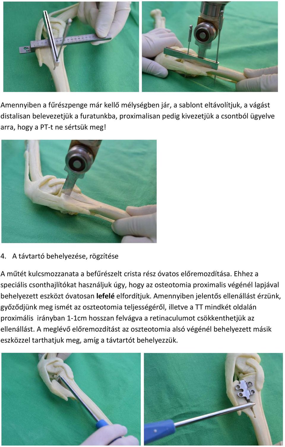 Ehhez a speciális csonthajlítókat használjuk úgy, hogy az osteotomia proximalis végénél lapjával behelyezett eszközt óvatosan lefelé elfordítjuk.