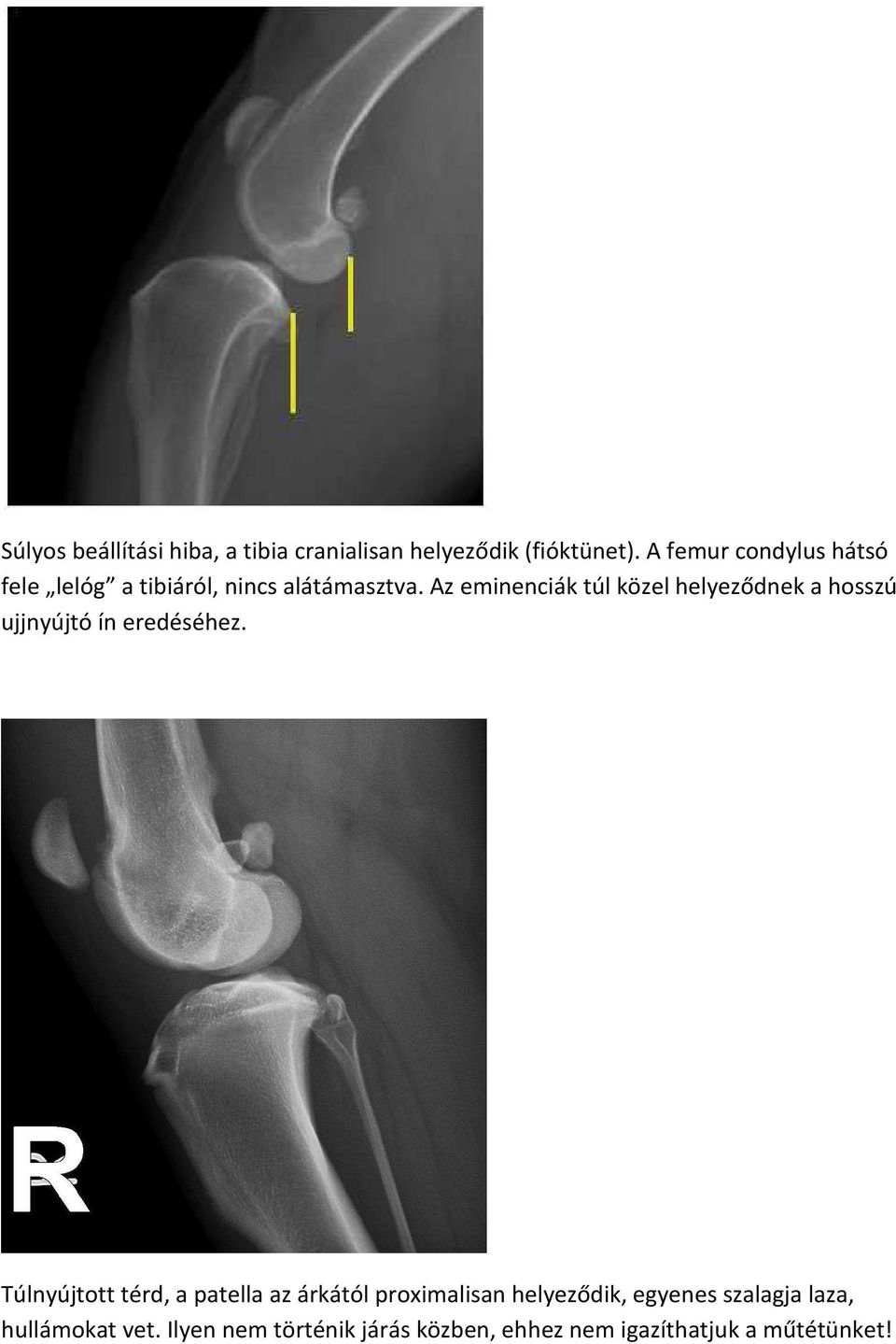 Az eminenciák túl közel helyeződnek a hosszú ujjnyújtó ín eredéséhez.