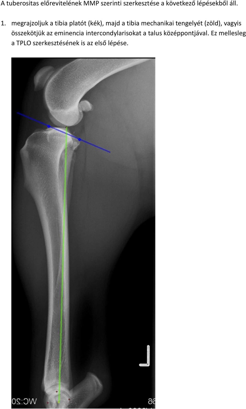 megrajzoljuk a tibia platót (kék), majd a tibia mechanikai tengelyét