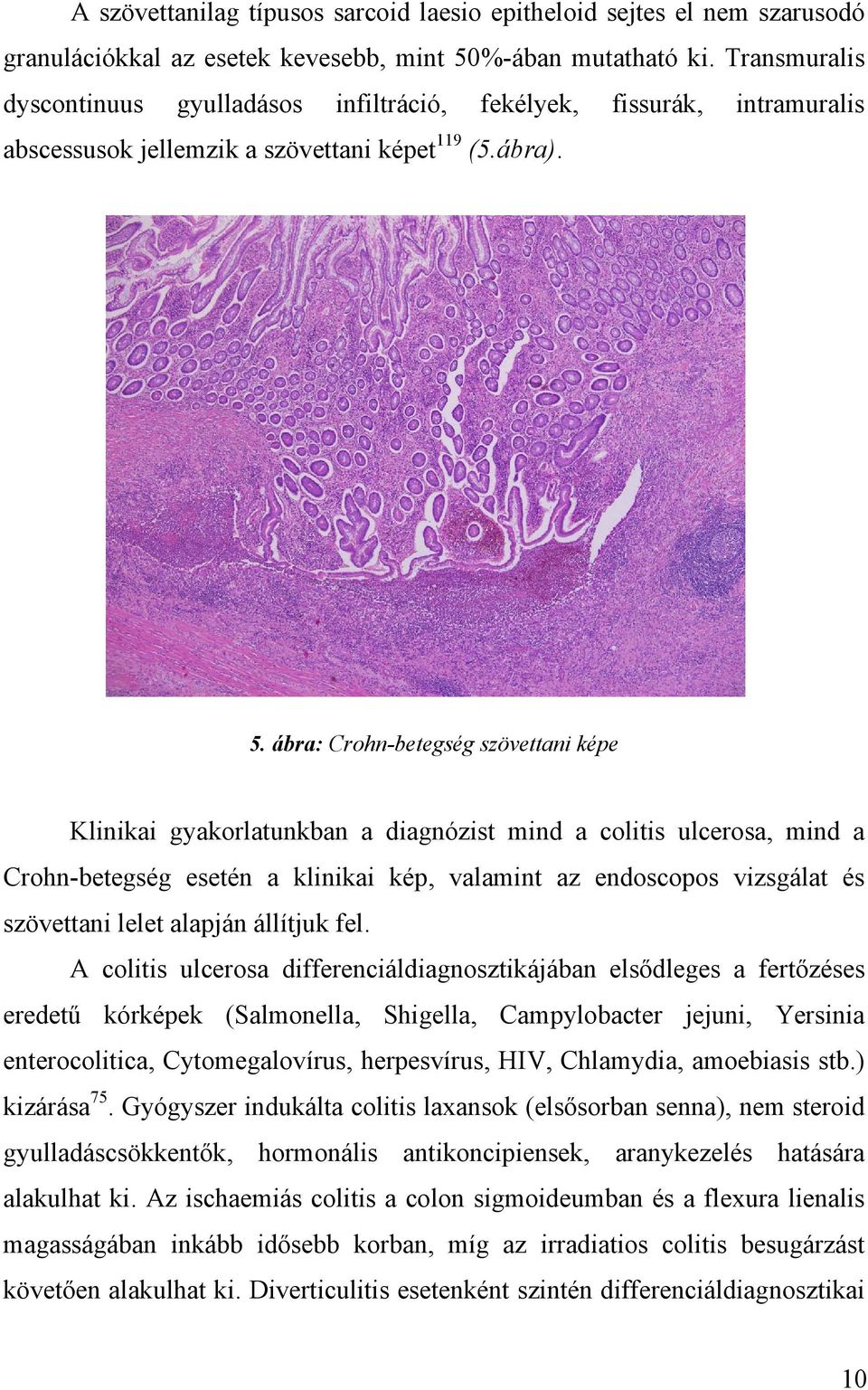 ábra: Crohn-betegség szövettani képe Klinikai gyakorlatunkban a diagnózist mind a colitis ulcerosa, mind a Crohn-betegség esetén a klinikai kép, valamint az endoscopos vizsgálat és szövettani lelet