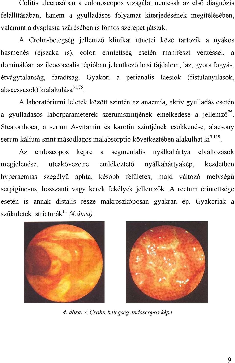 A Crohn-betegség jellemző klinikai tünetei közé tartozik a nyákos hasmenés (éjszaka is), colon érintettség esetén manifeszt vérzéssel, a dominálóan az ileocoecalis régióban jelentkező hasi fájdalom,