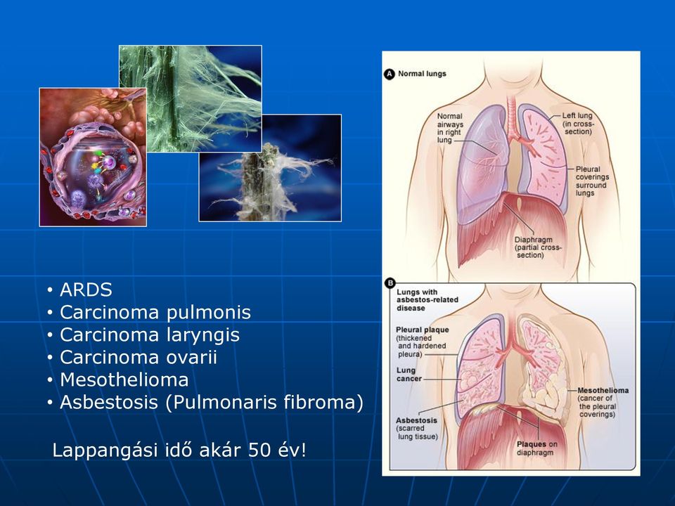 ovarii Mesothelioma Asbestosis