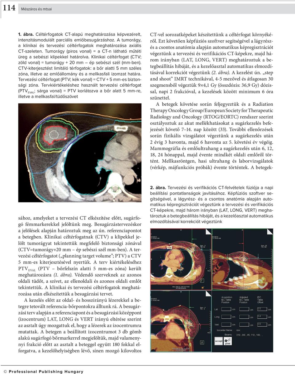 Klinikai céltérfogat (CTV; zöld vonal) = tumorágy + 20 mm ép sebészi szél (mm-ben).