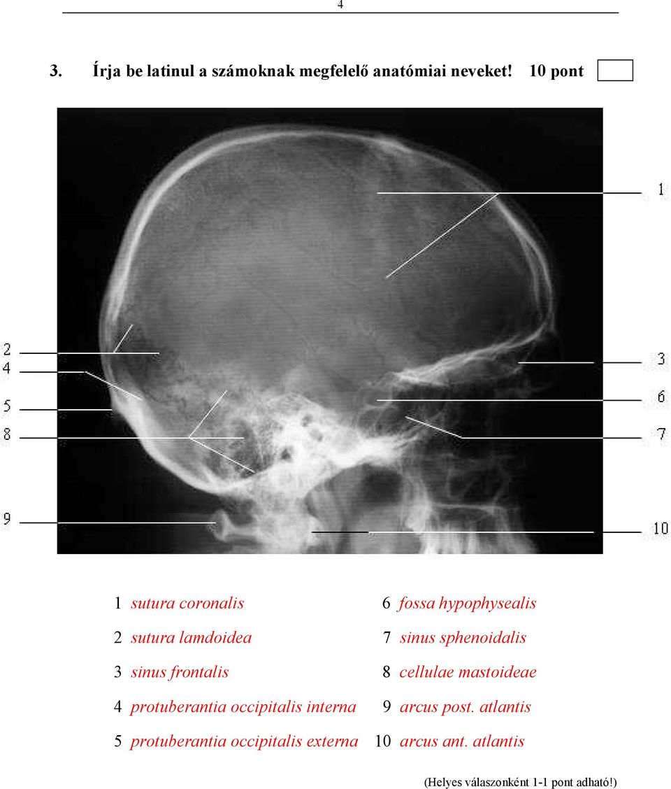 sphenoidalis 3 sinus frontalis 8 cellulae mastoideae 4 protuberantia