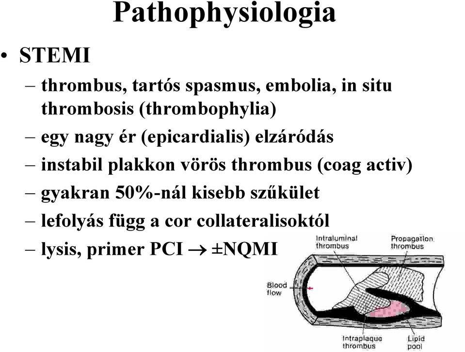 instabil plakkon vörös thrombus (coag activ) gyakran 50%-nál