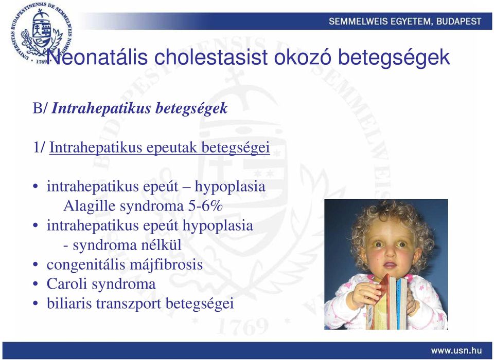 Alagille syndroma 5-6% intrahepatikus epeút hypoplasia - syndroma