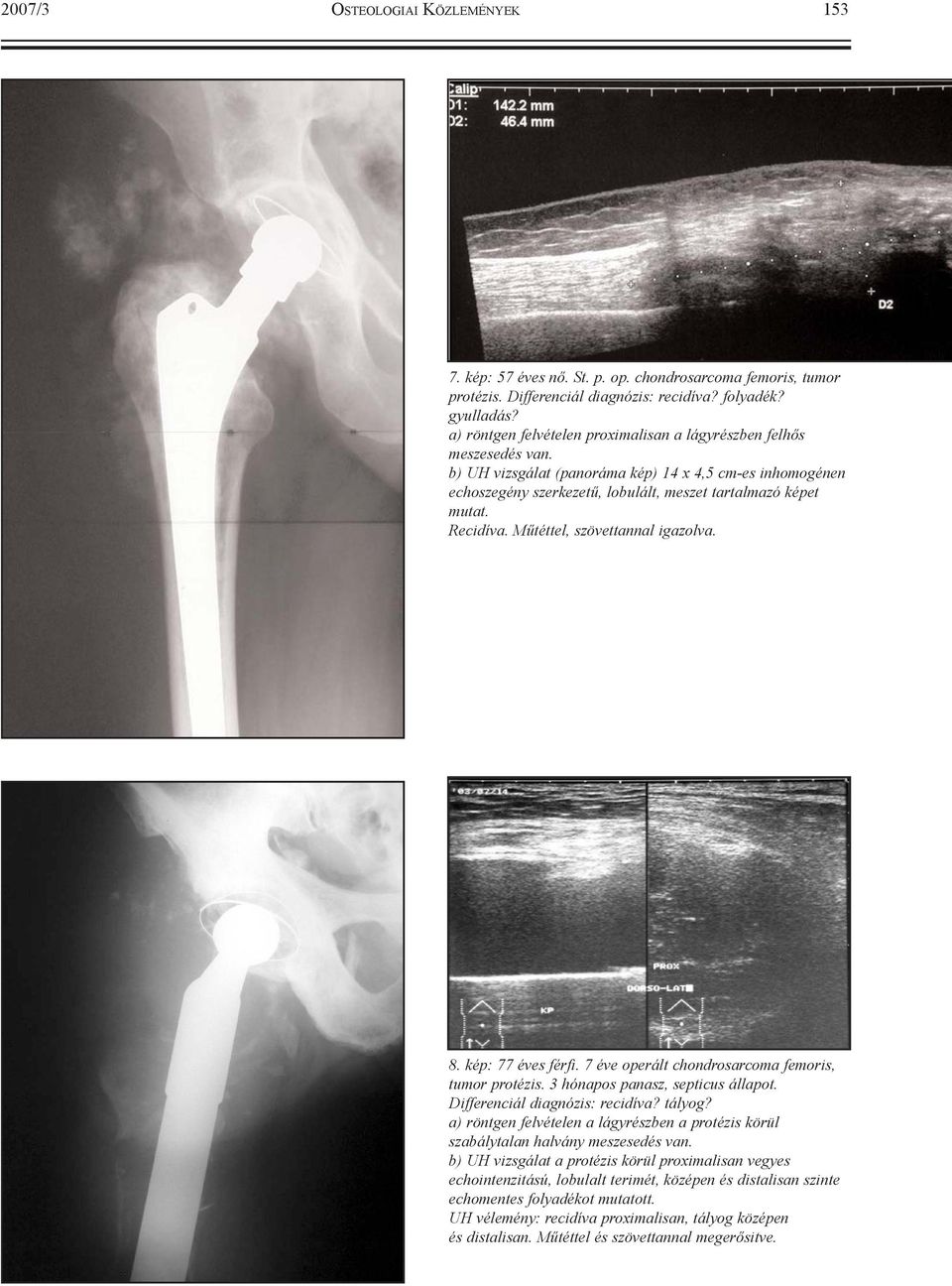 Recidíva. Mûtéttel, szövettannal igazolva. 8. kép: 77 éves férfi. 7 éve operált chondrosarcoma femoris, tumor protézis. 3 hónapos panasz, septicus állapot. Differenciál diagnózis: recidíva? tályog?