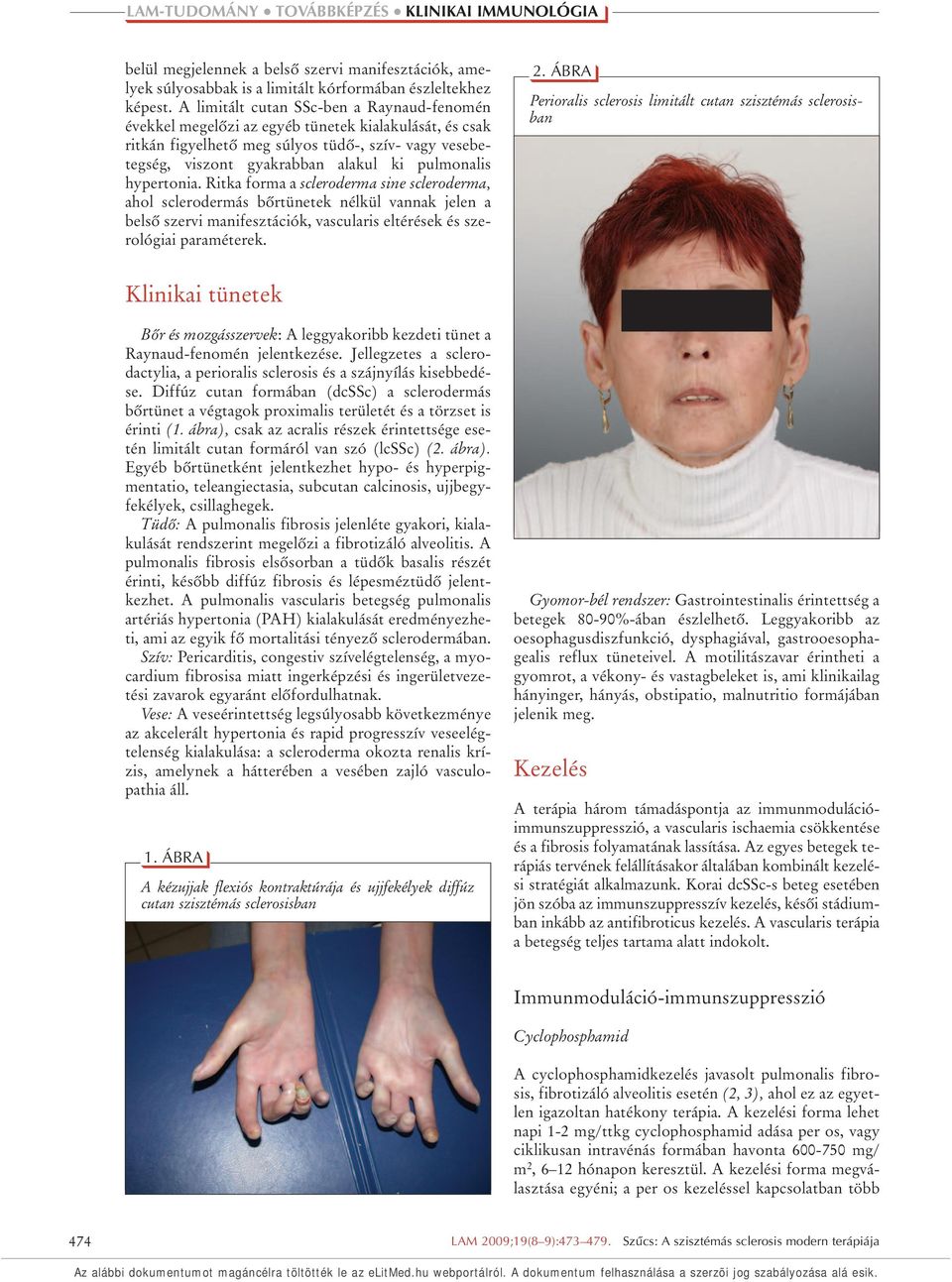 hypertonia. Ritka forma a scleroderma sine scleroderma, ahol sclerodermás bôrtünetek nélkül vannak jelen a belsô szervi manifesztációk, vascularis eltérések és szerológiai paraméterek. 2.