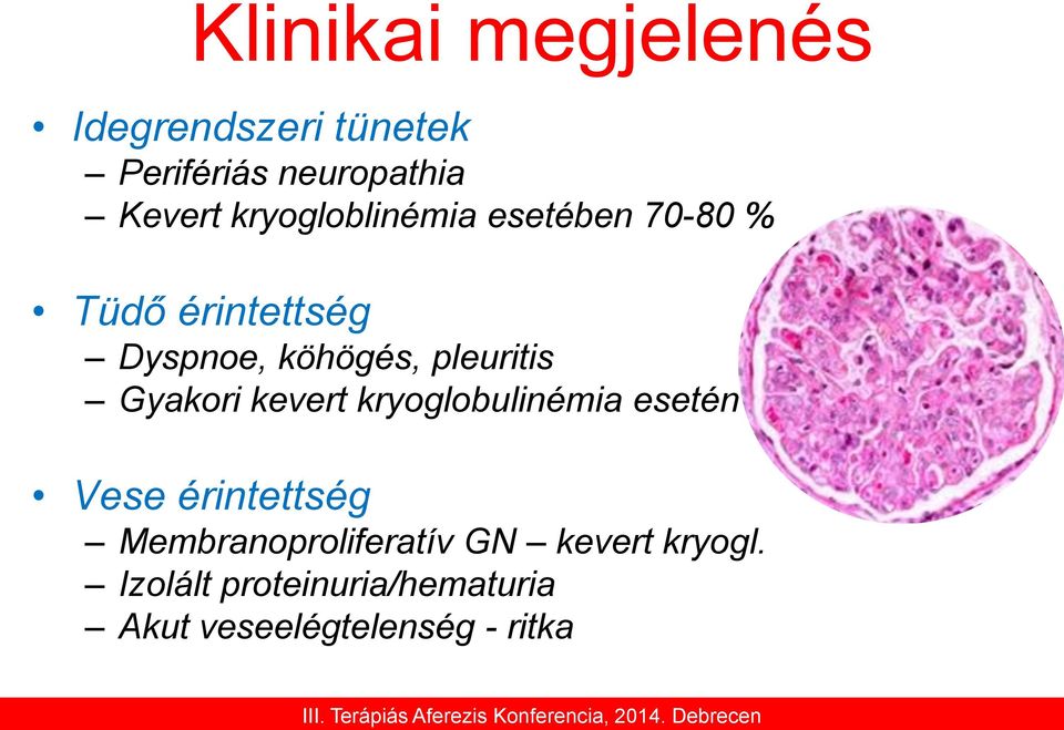 pleuritis Gyakori kevert kryoglobulinémia esetén Vese érintettség