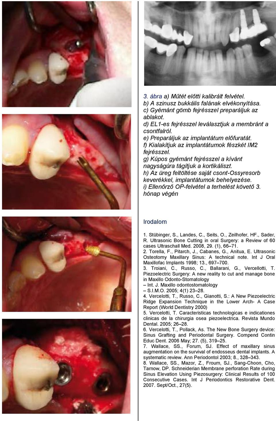 h) Az üreg feltöltése saját csont-ossyresorb keverékkel, implantátumok behelyezése. i) Ellenőrző OP-felvétel a terhelést követő 3. hónap végén Irodalom 1. Stübinger, S., Landes, C., Seits, O.