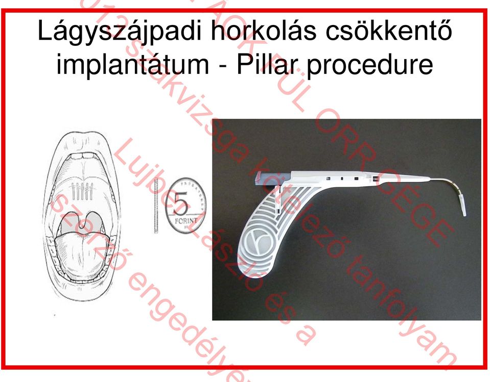 Pillar procedure 013