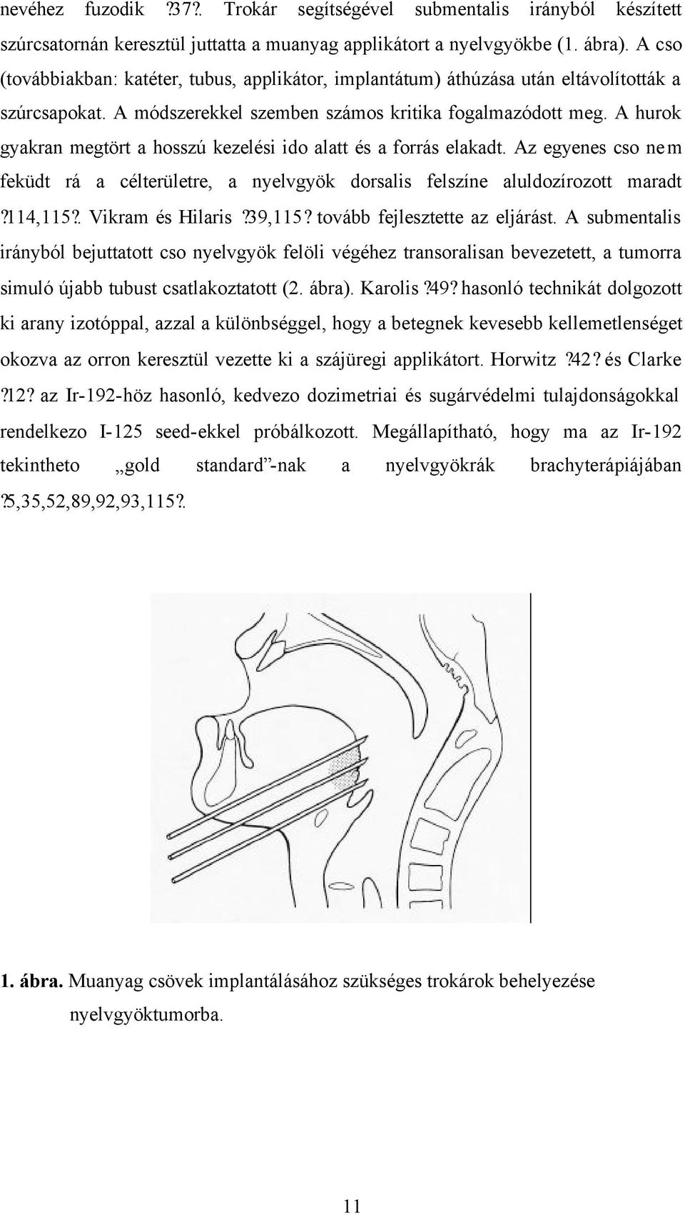 A hurok gyakran megtört a hosszú kezelési ido alatt és a forrás elakadt. Az egyenes cso nem feküdt rá a célterületre, a nyelvgyök dorsalis felszíne aluldozírozott maradt?114,115?. Vikram és Hilaris?