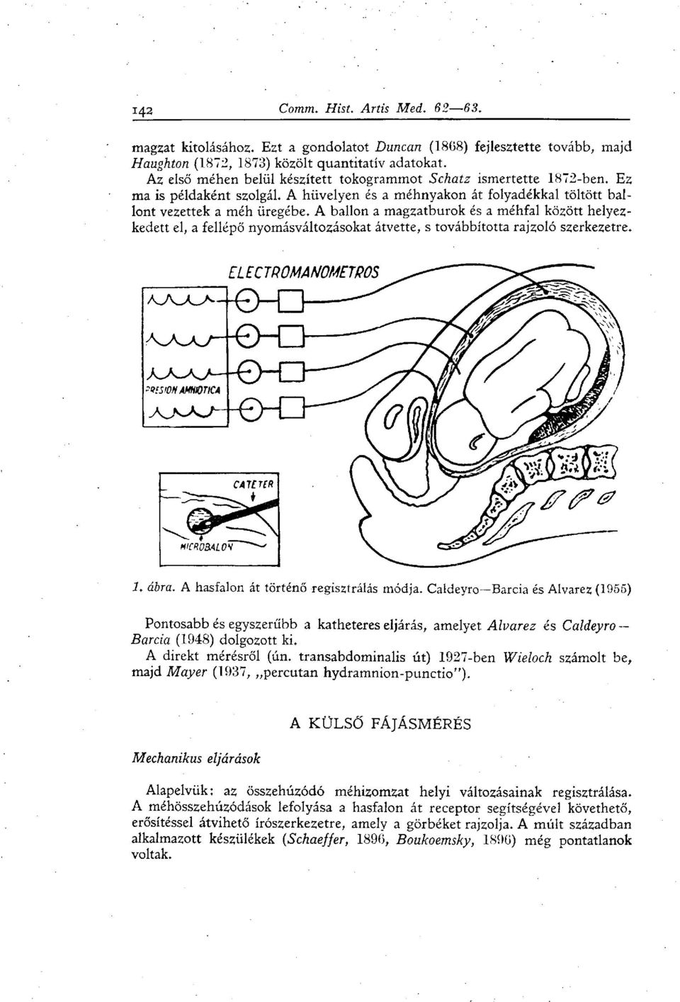 A ballon a magzatburok és a méhfal között helyezkedett el, a fellépő nyomásváltozásokat átvette, s továbbította rajzoló szerkezetre. 1. ábra. A hasfalon át történő regisztrálás módja.