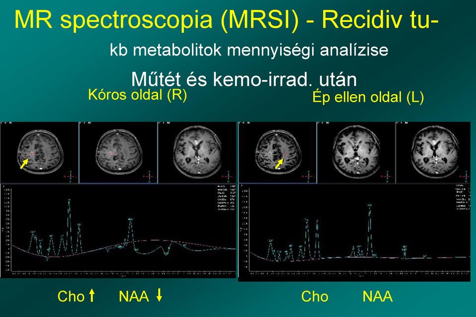 analízise Műtét és kemo-irrad.