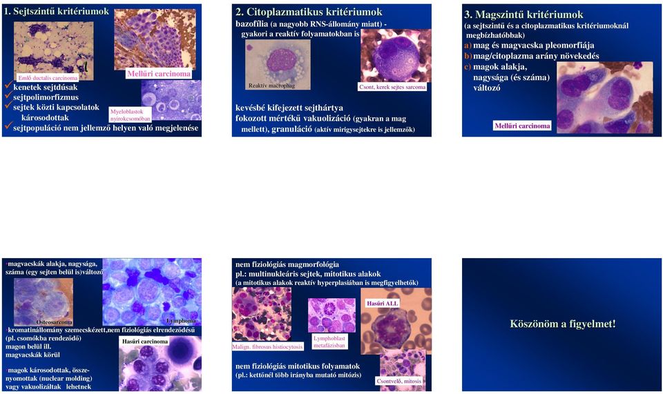 carcinoma kenetek sejtdúsak sejtpolimorfizmus sejtek közti kapcsolatok Myeloblastok károsodottak nyirokcsomóban sejtpopuláció nem jellemz helyen való megjelenése magvacskák alakja, nagysága, száma