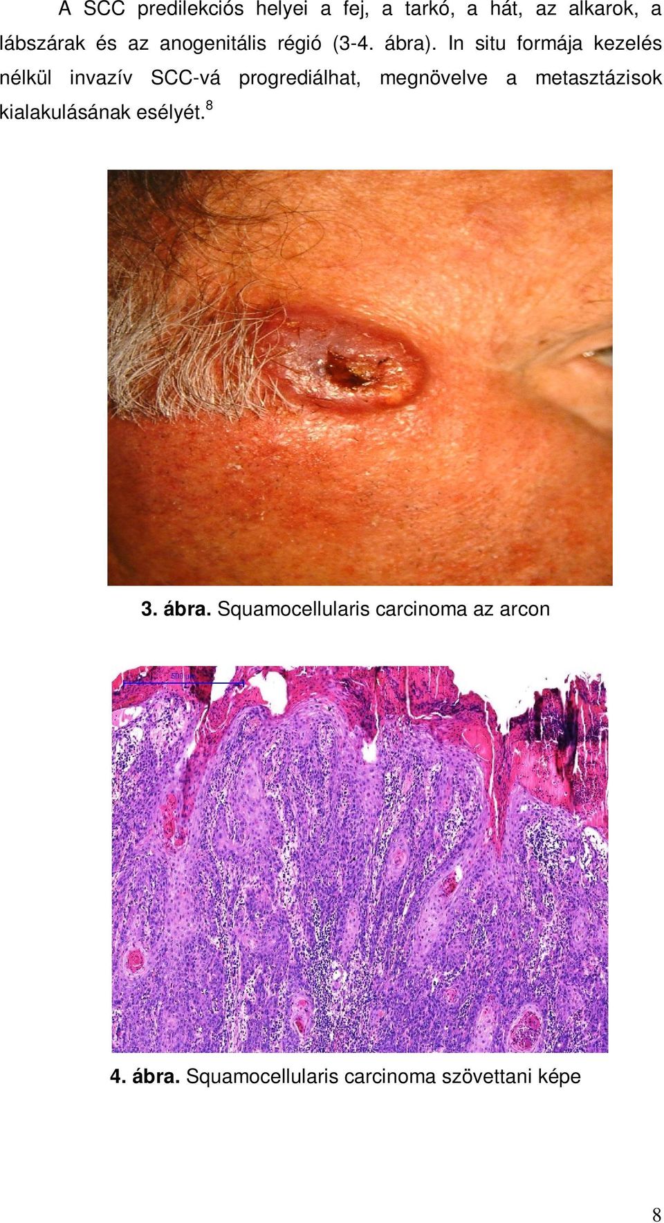 In situ formája kezelés nélkül invazív SCC-vá progrediálhat, megnövelve a