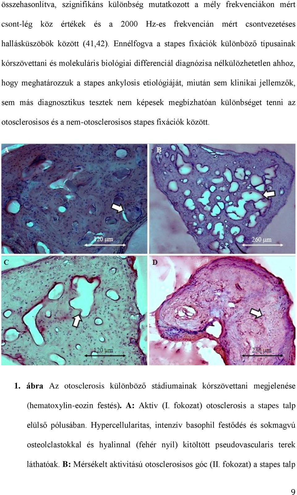 klinikai jellemzők, sem más diagnosztikus tesztek nem képesek megbízhatóan különbséget tenni az otosclerosisos és a nem-otosclerosisos stapes fixációk között. 1.