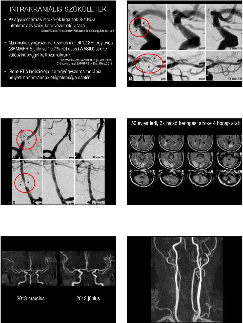 7% két éves (WASID) strokevalószínűséggel kell számolnunk Chimowitz MI et al. WASID. N Engl J Med. 2005 Chimowitz MI et al.