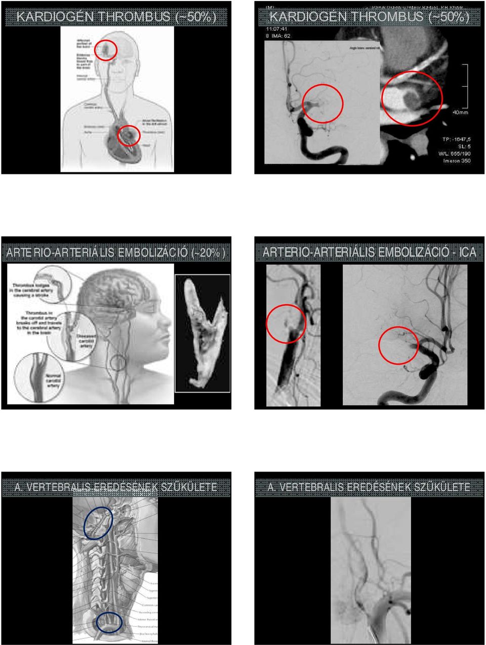 ARTERIO-ARTERIÁLIS EMBOLIZÁCIÓ - ICA A.