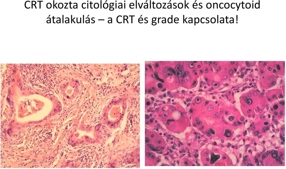 oncocytoid átalakulás