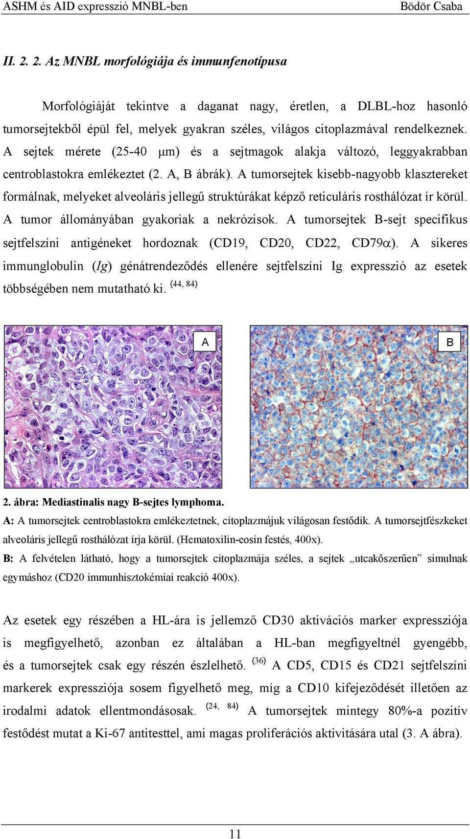 A tumorsejtek kisebb-nagyobb klasztereket formálnak, melyeket alveoláris jellegű struktúrákat képző reticuláris rosthálózat ír körül. A tumor állományában gyakoriak a nekrózisok.